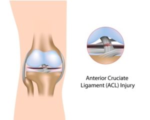 Knee Anterior Cruciate Ligament injury