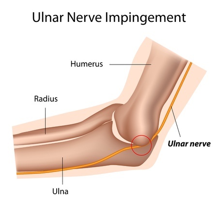 Ulnar Nerve Impingement and Entrapment Injuries